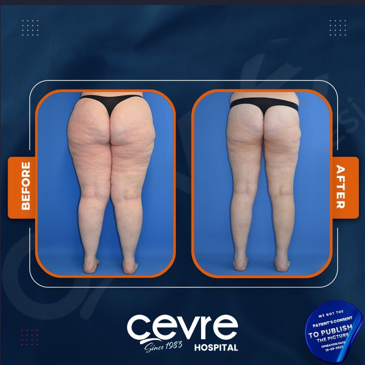 نتائج شد الفخذين قبل وبعد في Adem and Havva Medical Center، تحسين شكل الساقين