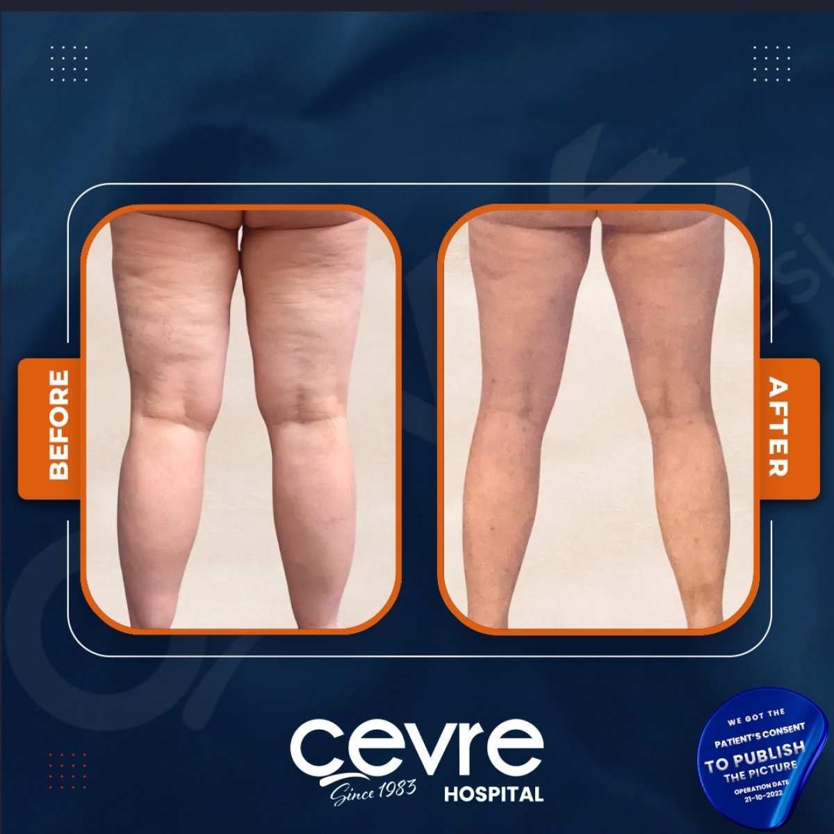Before and after thigh lift results at Adem and Havva Medical Center, improved leg contour