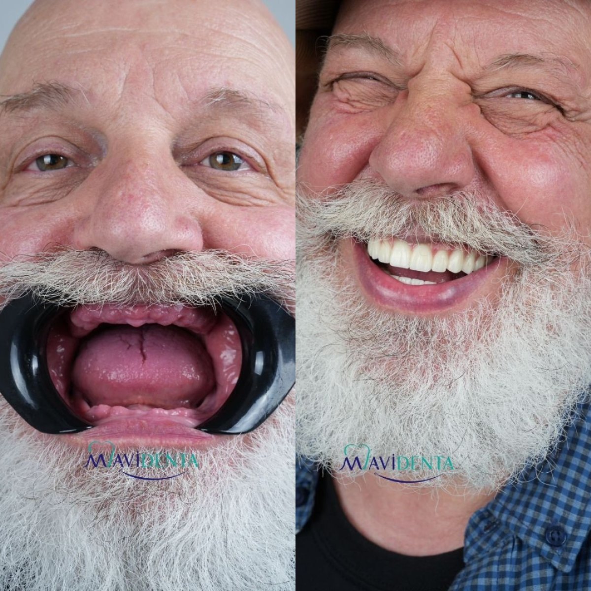 نتيجة قبل وبعد زراعة الأسنان All-on-4 في Good Look Clinic، ابتسامة مستعادة