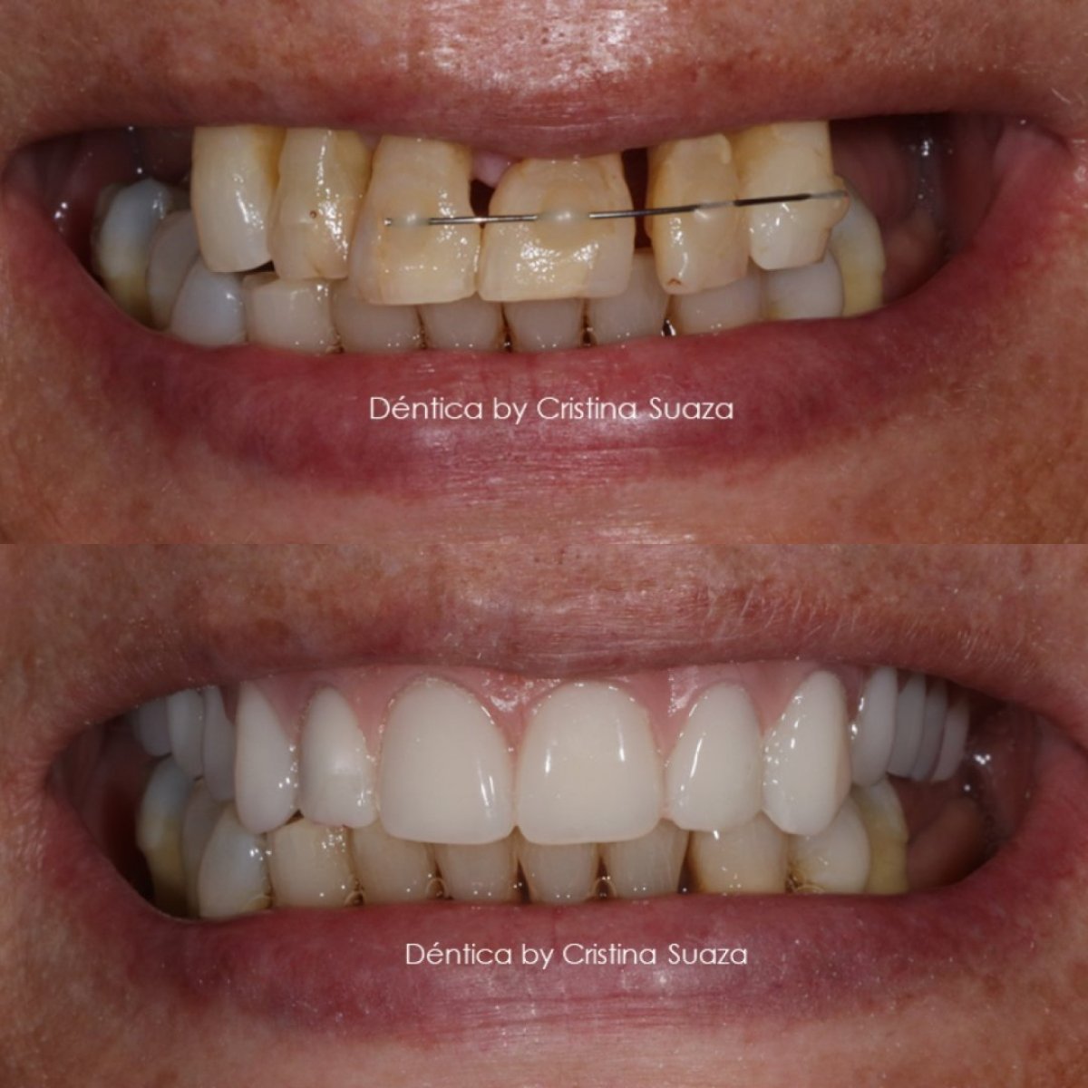 Resultados antes y después de implantes dentales All-on-4 de zirconia en Dentica by Cristina Suaza