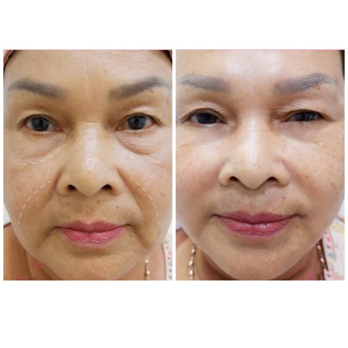 Resultados de lipofilling antes y después en Somchai Clinic – rejuvenecimiento facial y volumen