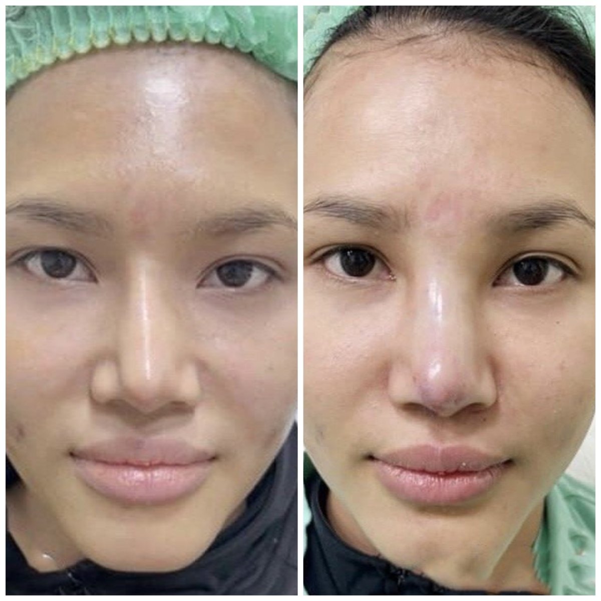 نتائج عملية تجميل الأنف قبل وبعد في عيادة سومشاي، إعادة تشكيل الأنف بمظهر طبيعي