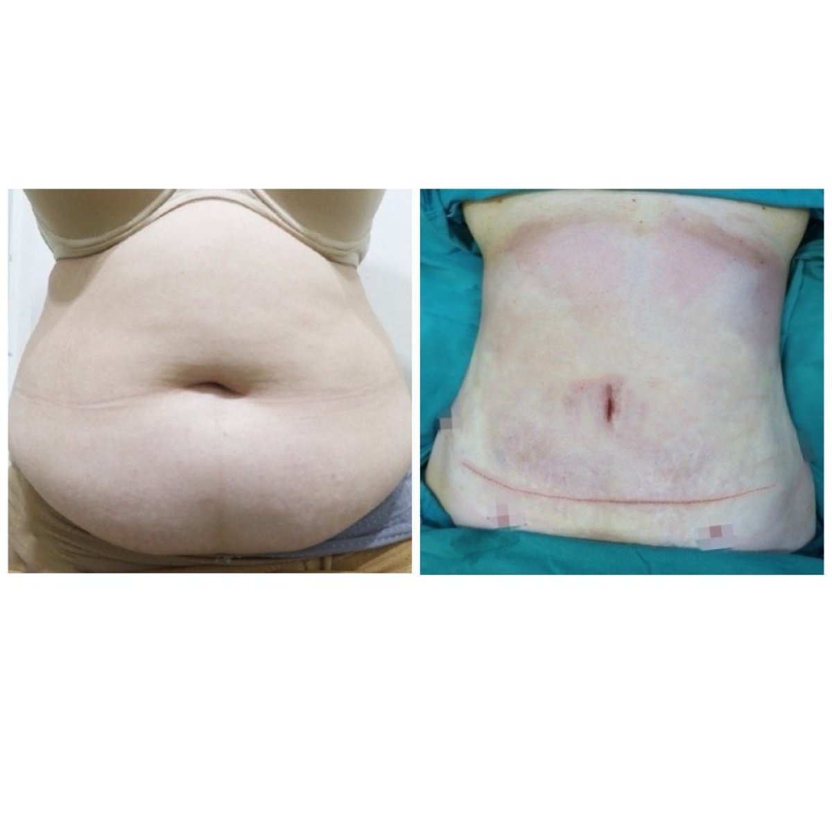 Resultados de liposucción antes y después en Somchai Clinic, mejora visible del abdomen