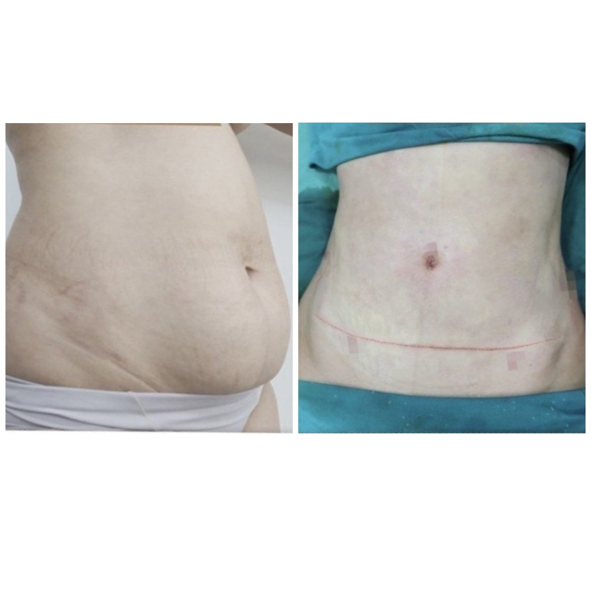Resultados de liposucción antes y después en Somchai Clinic – mejora visible del abdomen