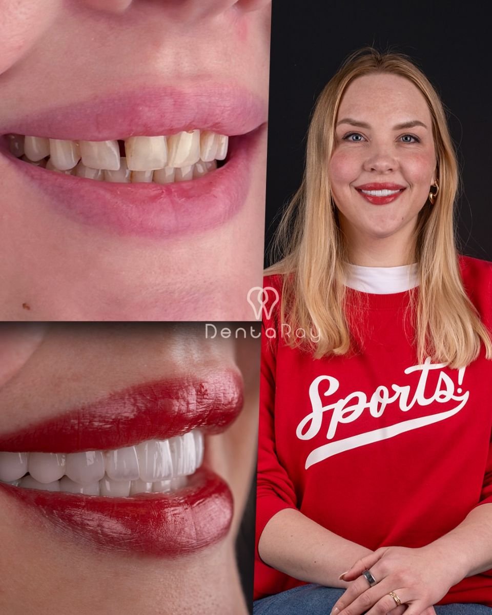 نتائج تبييض الأسنان قبل وبعد في عيادة Dentaray، ابتسامة أكثر إشراقًا