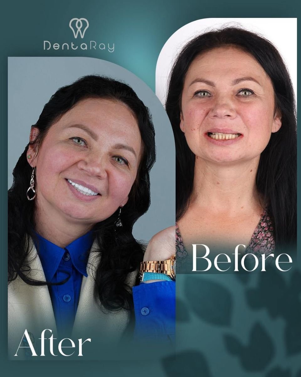 Before and after tooth whitening results at Dentaray Clinic, visibly brighter smile transformation