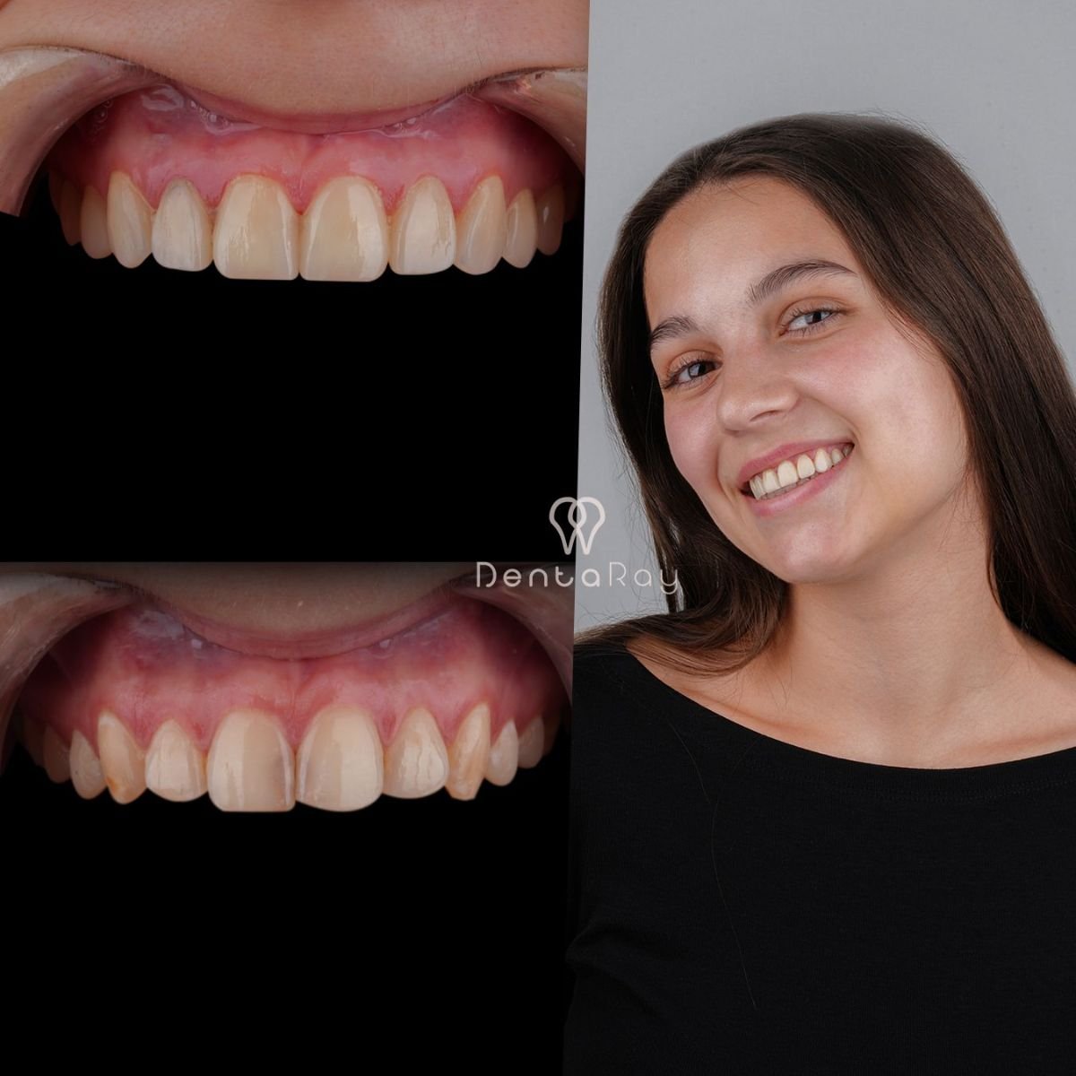 نتائج تبييض الأسنان قبل وبعد في عيادة Dentaray، ابتسامة أكثر إشراقًا بشكل واضح