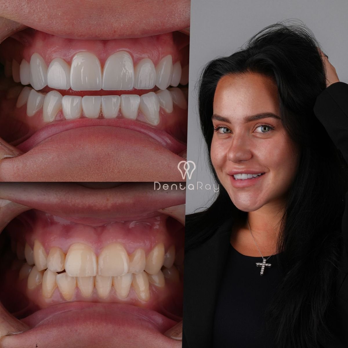 نتائج قبل وبعد عدسات الأسنان في عيادة Dentaray – تحول الابتسامة
