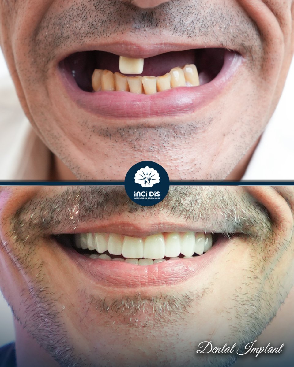 before and after photo