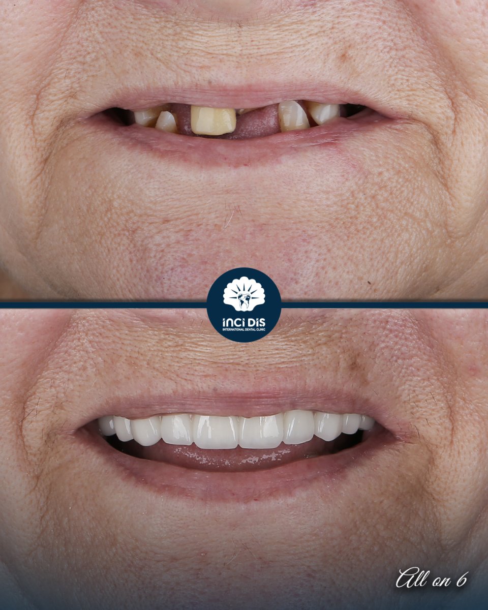 before and after photo