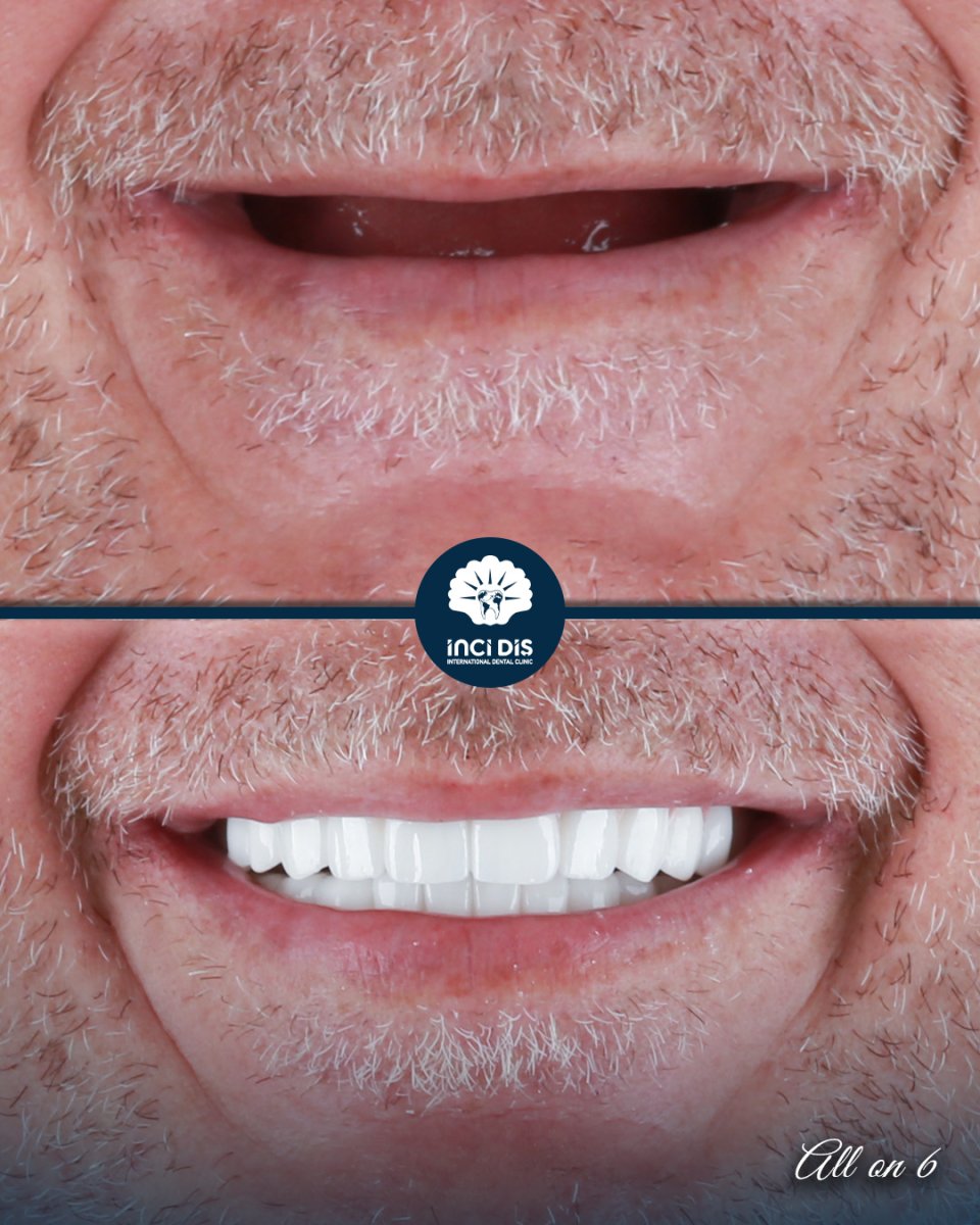 before and after photo