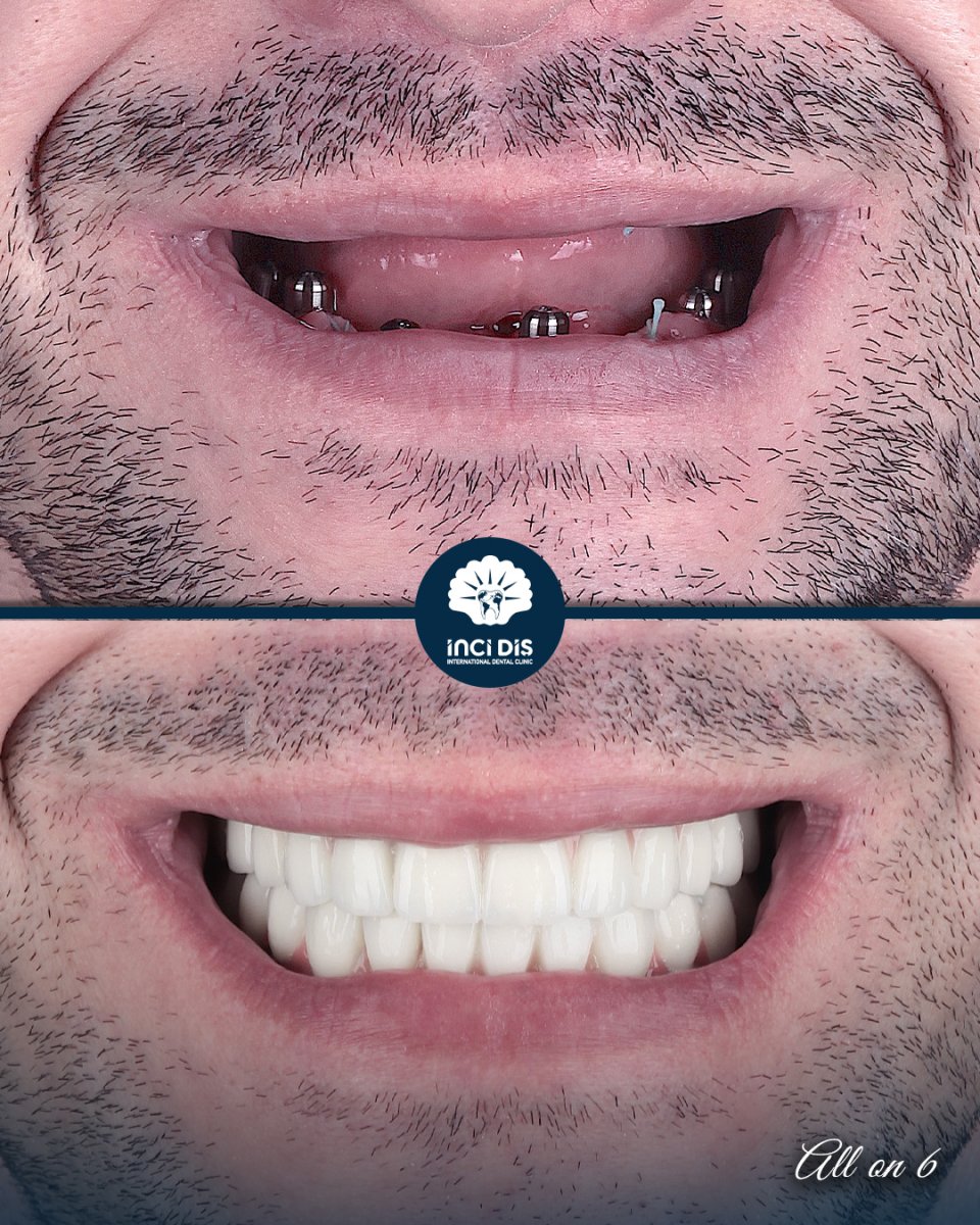 before and after photo