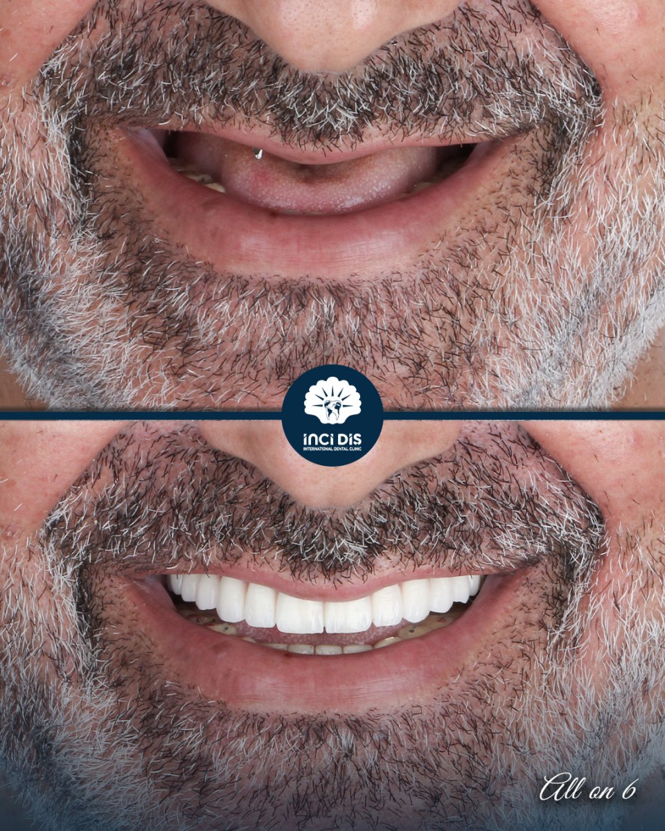 before and after photo