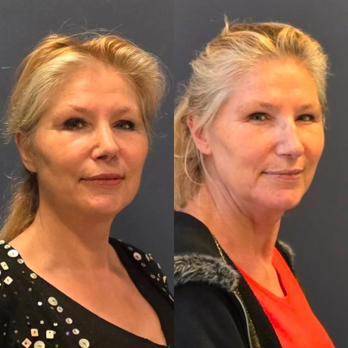 Resultados de lipofilling facial antes y después en Turan Turan Health Group, mejora visible