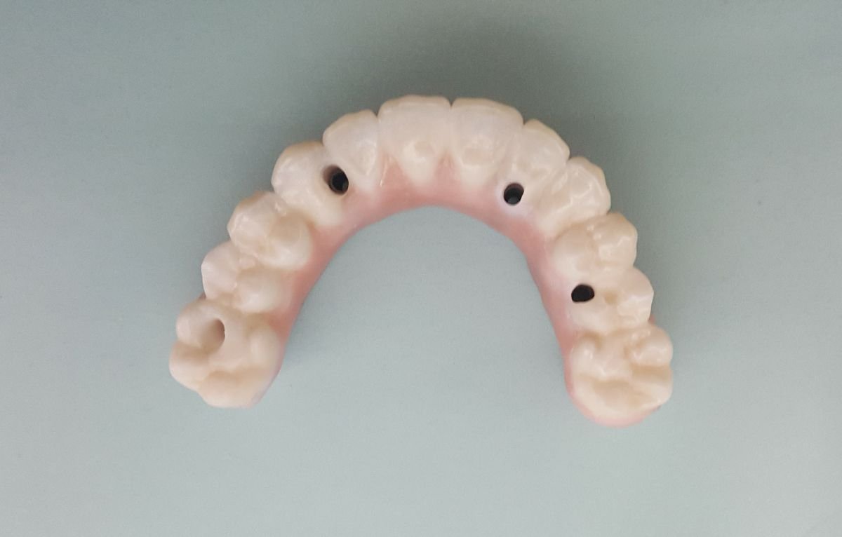 Resultado de prótesis All-on-6 en maxilar superior en SoftDentalCare Clinic