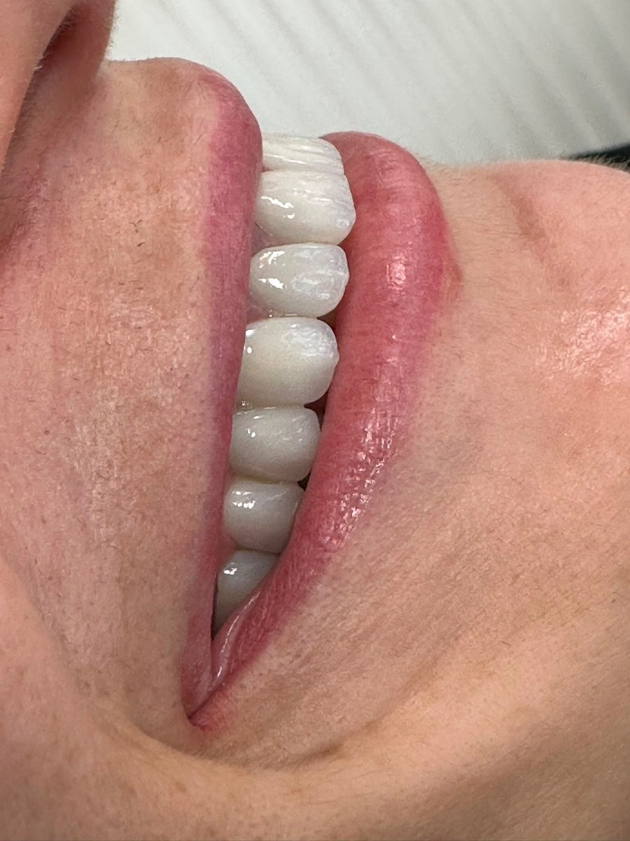 نتيجة زراعة الأسنان All-on-4 في عيادة Ader Dent، ابتسامة محسنة بعد العلاج