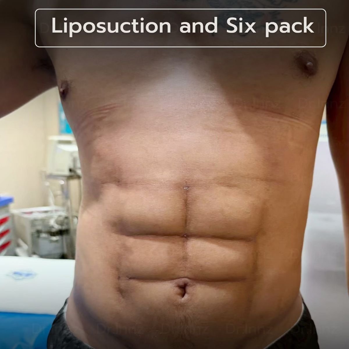 Resultado de liposucción y abdominales marcados en Intrarat Hospital – abdomen definido