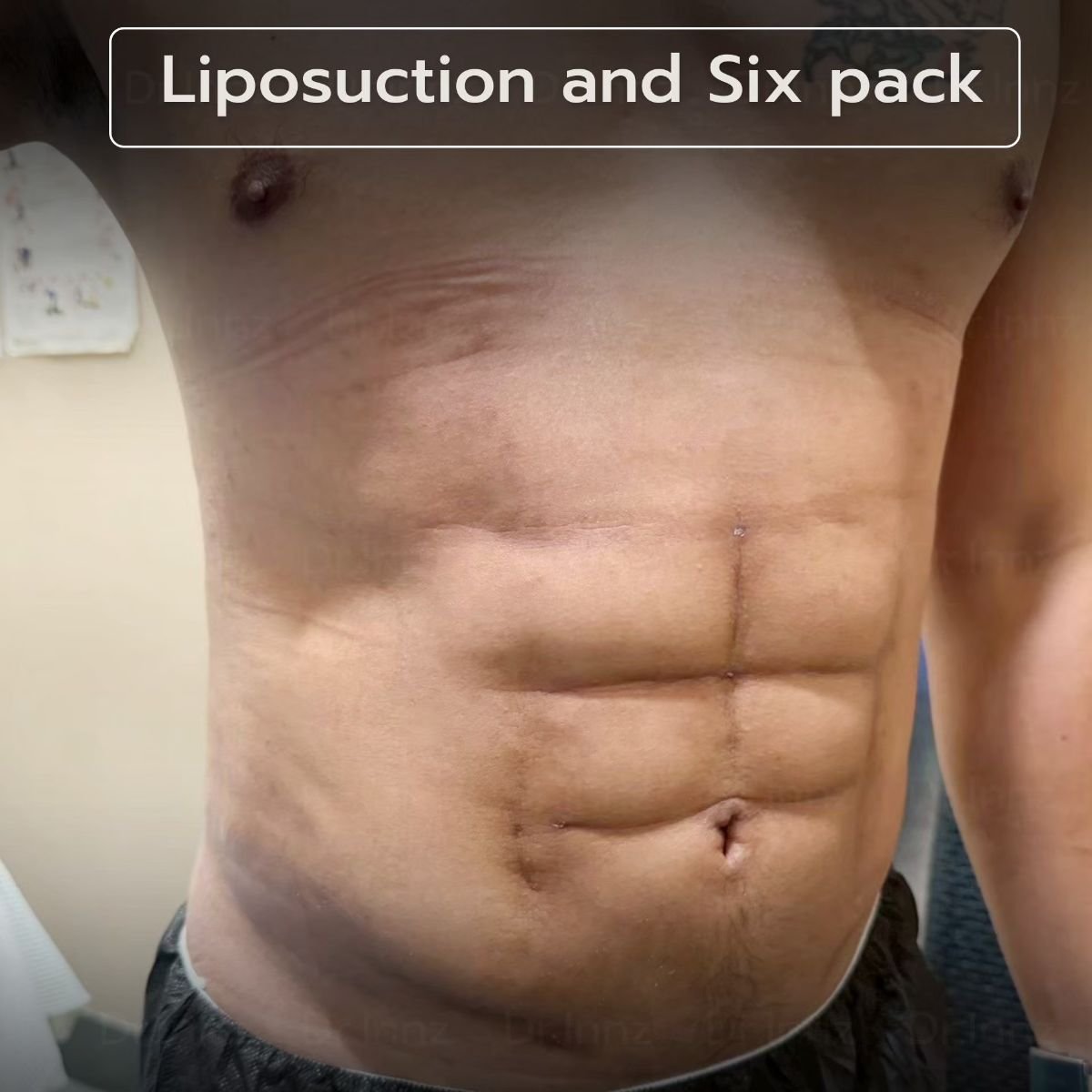 Abdominales marcados tras liposucción en Intrarat Hospital – resultado de contorno definido