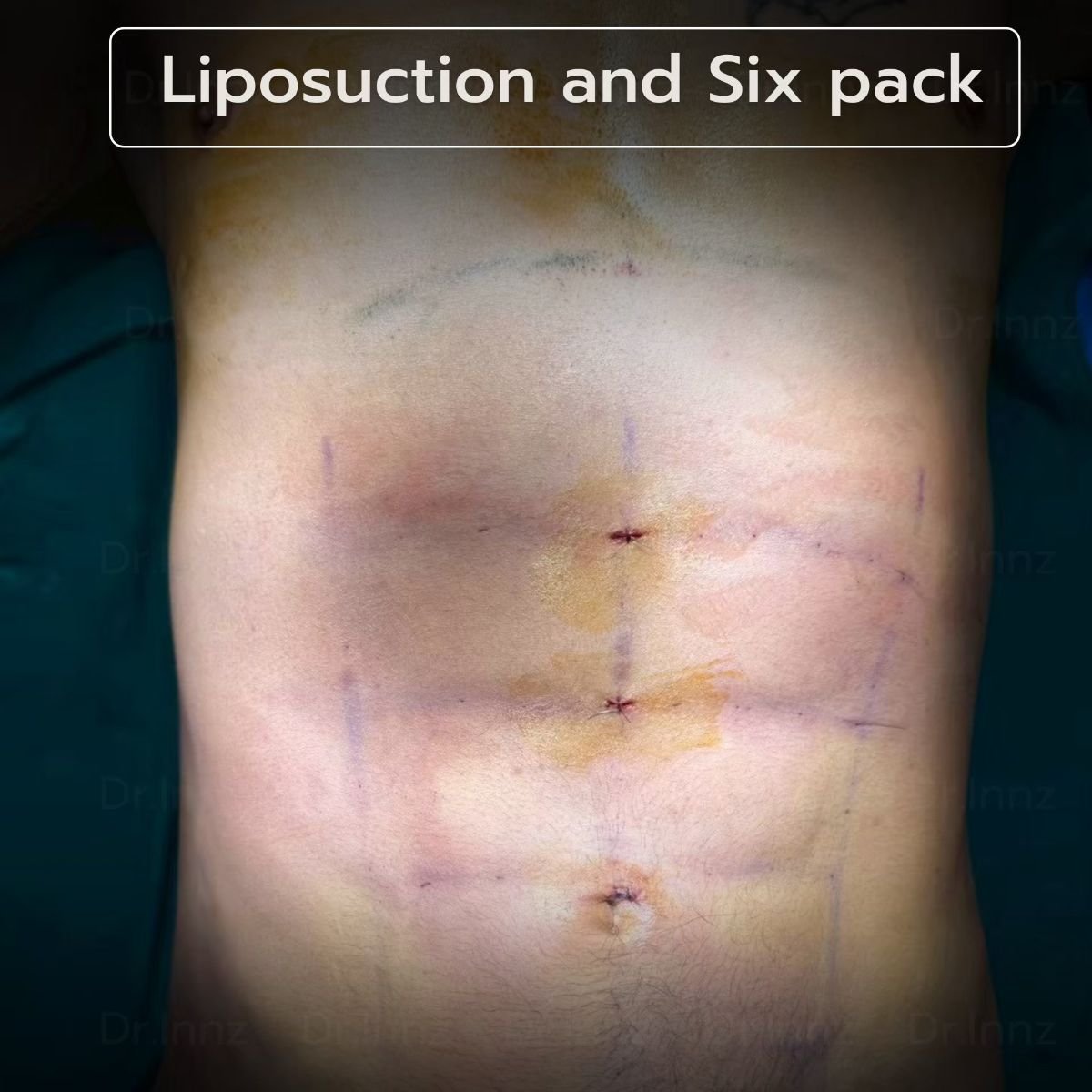 Resultado de liposucción y marcación de abdomen en Intrarat Hospital – abdomen definido