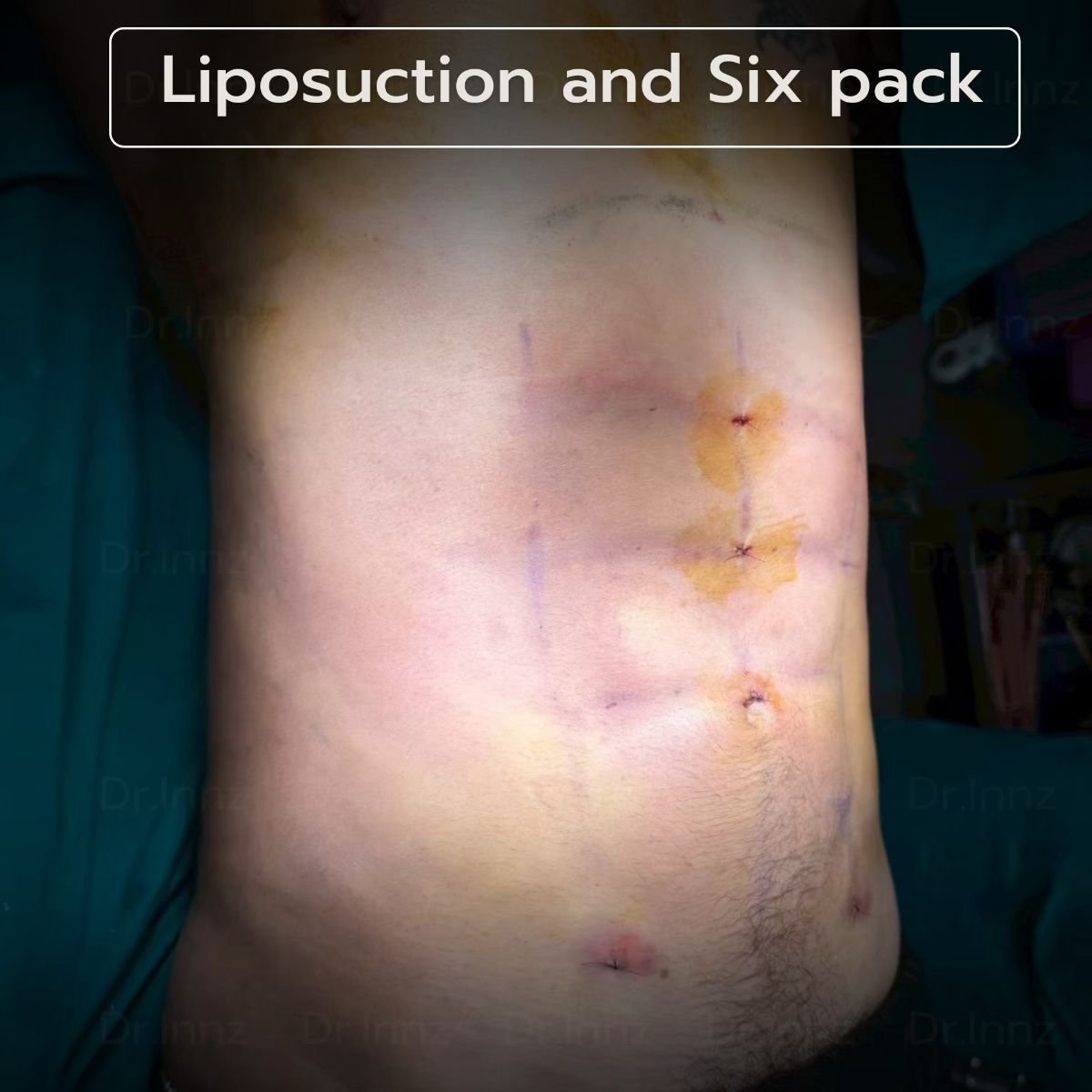 Resultado de liposucción de six pack en Intrarat Hospital: abdominales definidos