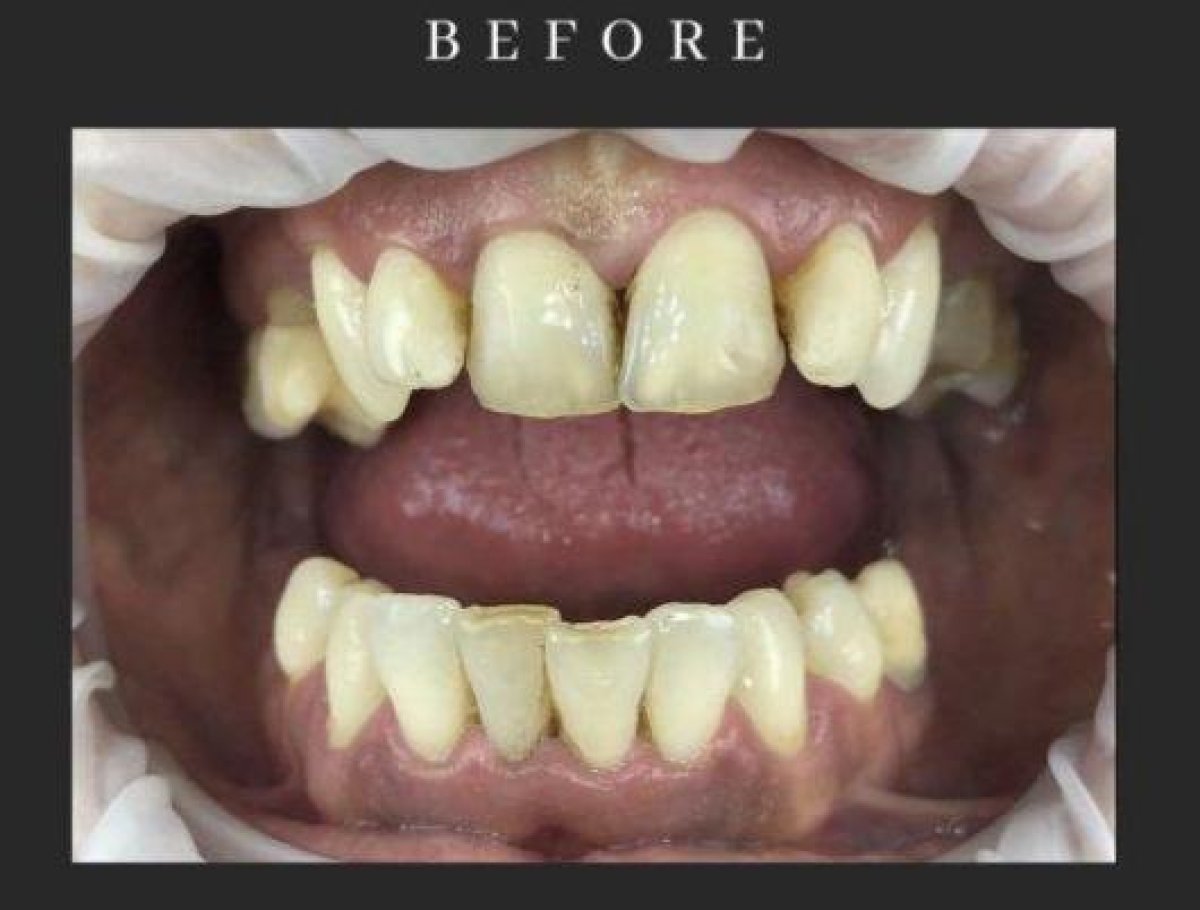 قبل زراعة الأسنان All-on-6 في Dental Club Karadzhovi، فقدان شديد للأسنان