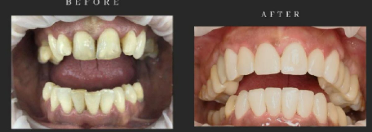 نتيجة قبل وبعد زراعة الأسنان All-on-6 في Dental Club Karadzhovi، ابتسامة مستعادة