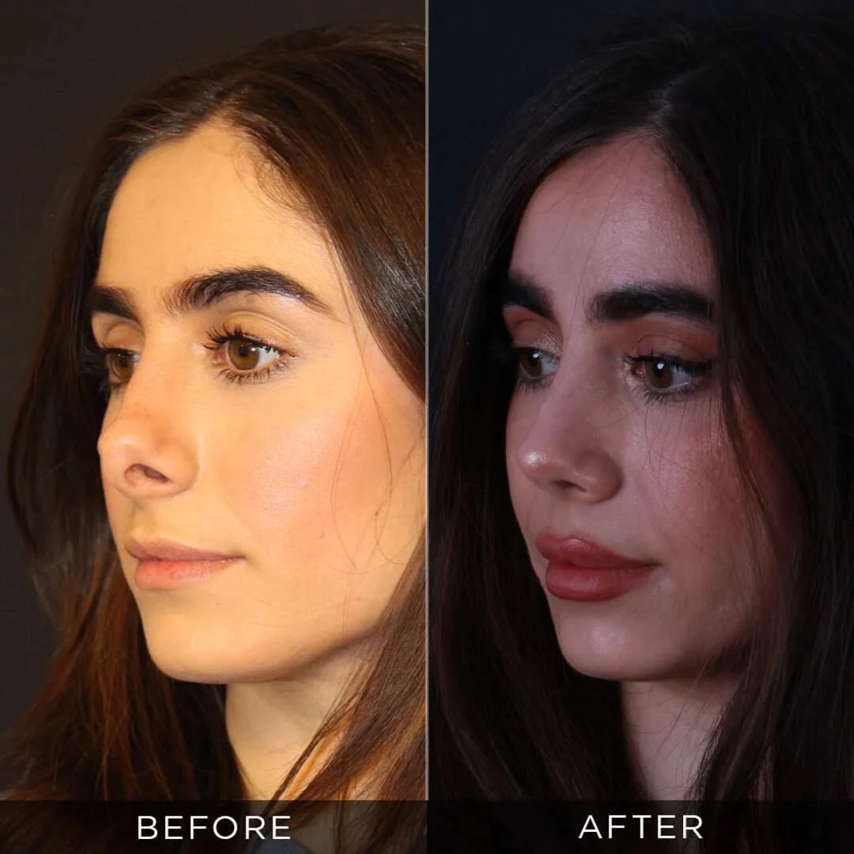 نتائج قبل وبعد عملية تجميل الأنف التصحيحية في عيادة د. حسن دويغولو تركيا