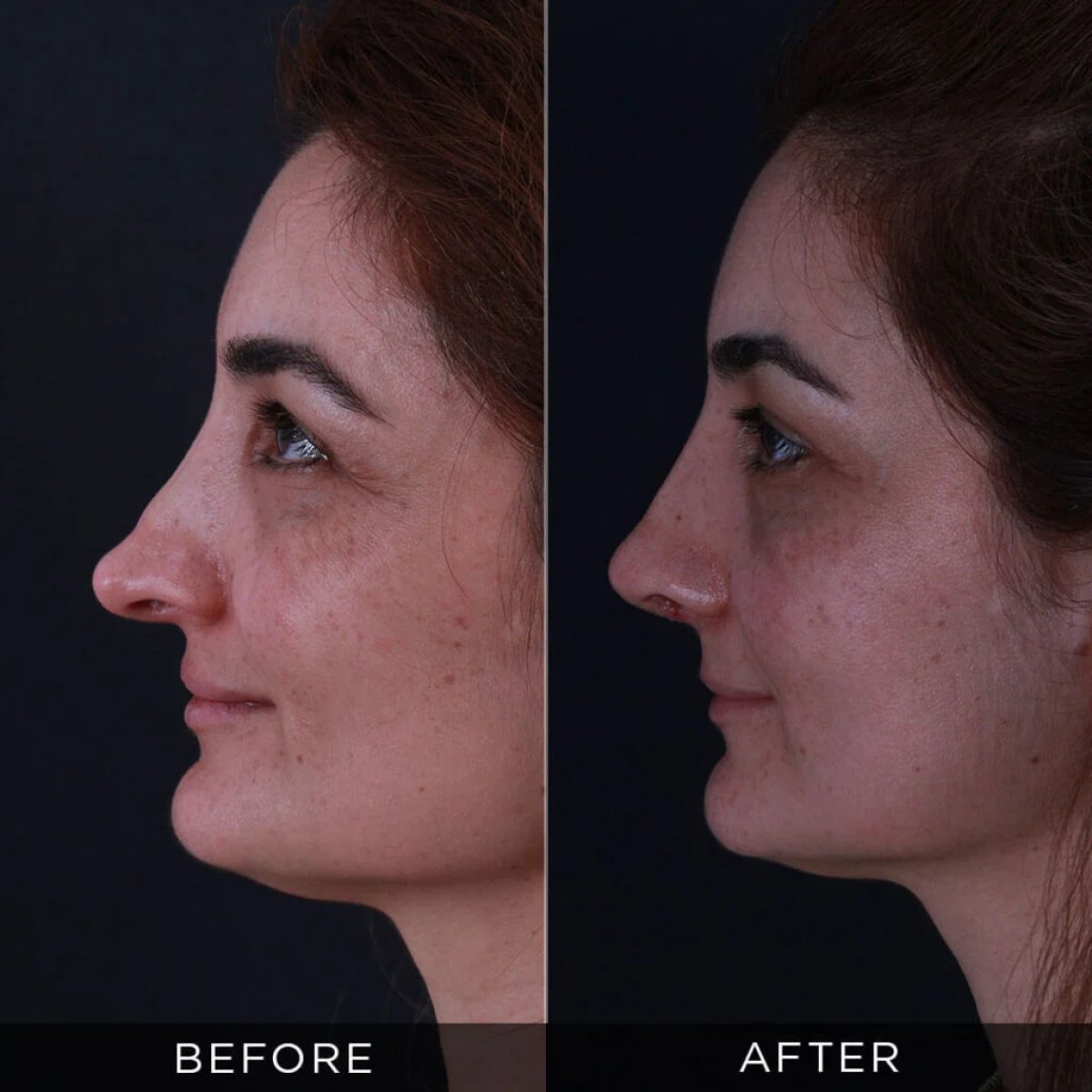 Résultat avant/après rhinoplastie secondaire chez Dr. Hasan Duygulu - Face Aesthetics Clinic Turkey