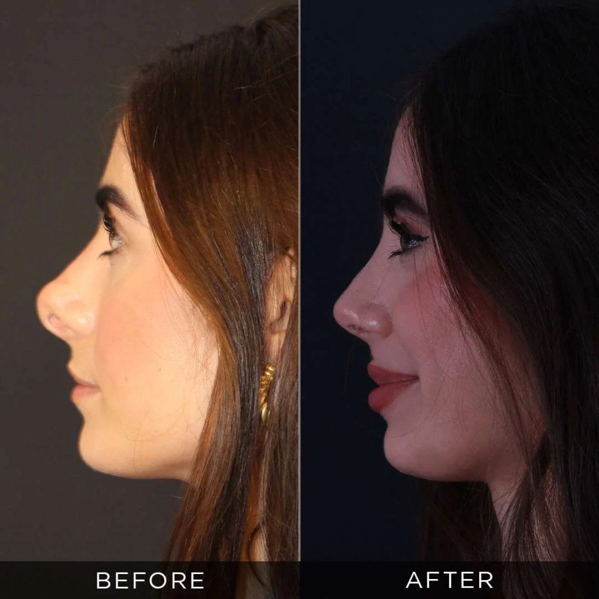 Résultats avant et après rhinoplastie secondaire chez Dr. Hasan Duygulu - Face Aesthetics Clinic Turkey