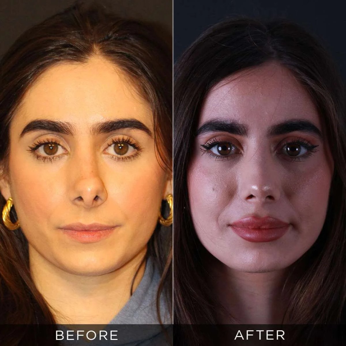 نتائج قبل وبعد عملية تجميل الأنف التصحيحية في عيادة د. حسن دويغولو تركيا