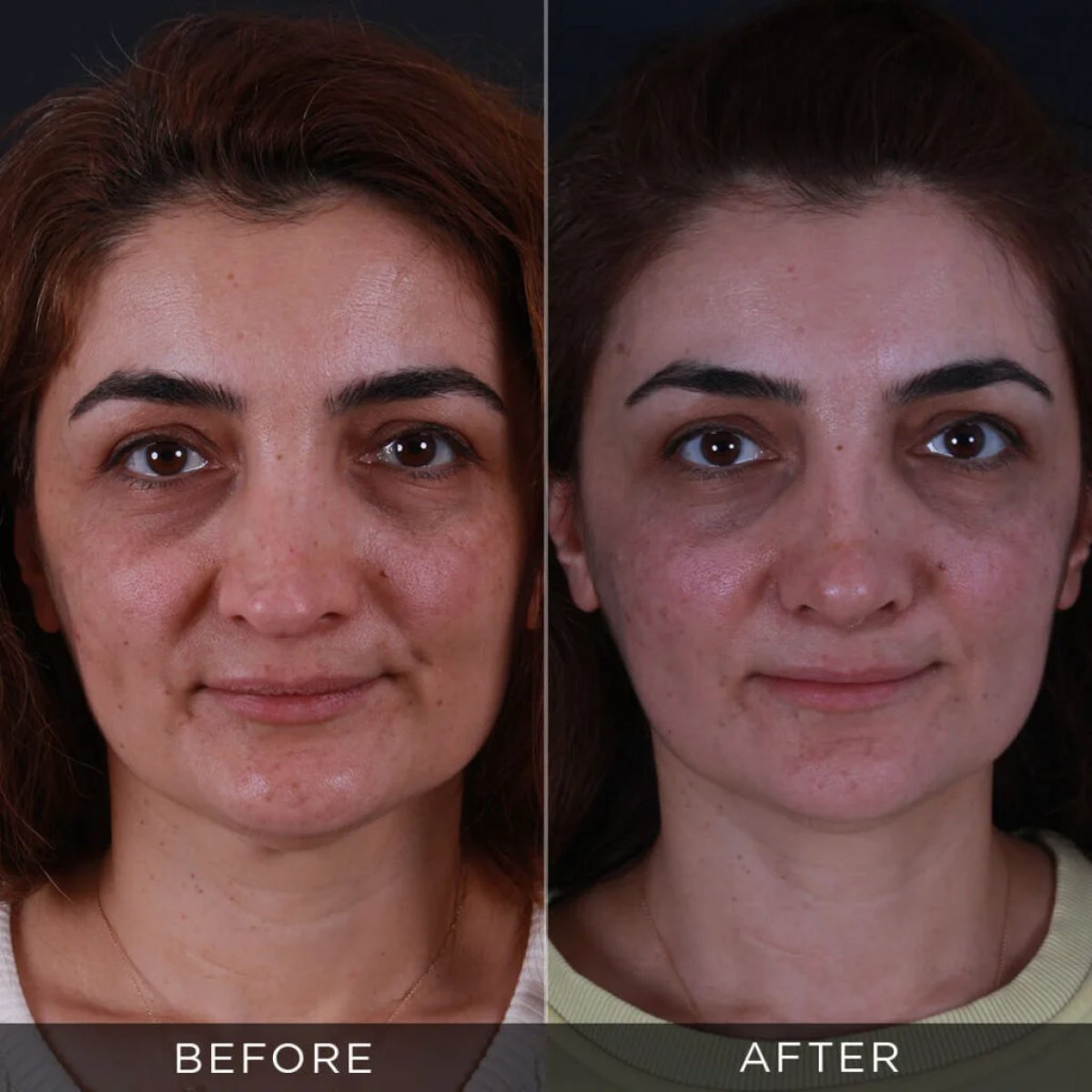 نتائج تجميل الأنف التصحيحي قبل وبعد في عيادة Dr. Hasan Duygulu - Face Aesthetics Clinic Turkey