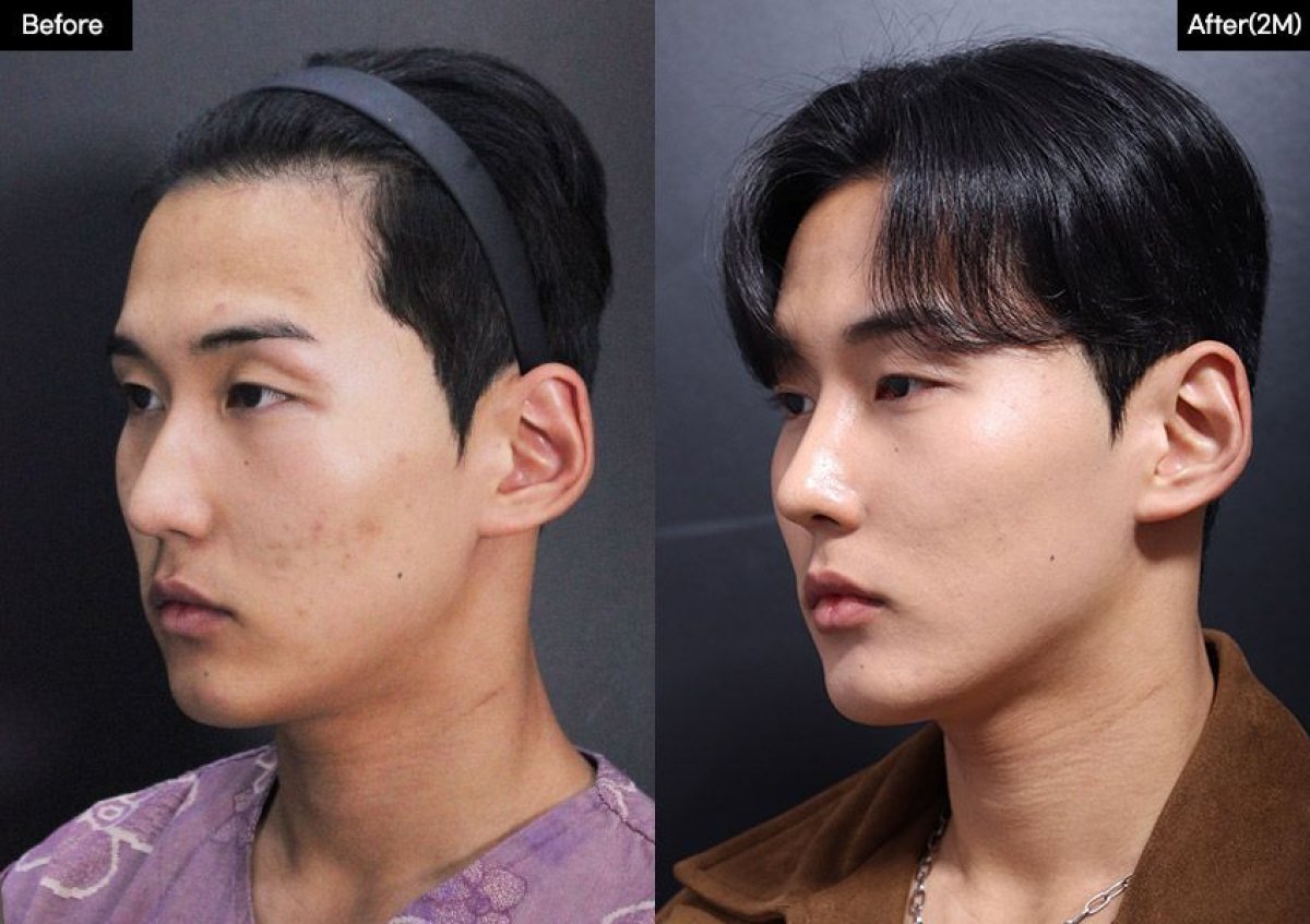 Результати ринопластики до і після у VG Plastic Surgery, покращена форма та профіль носа