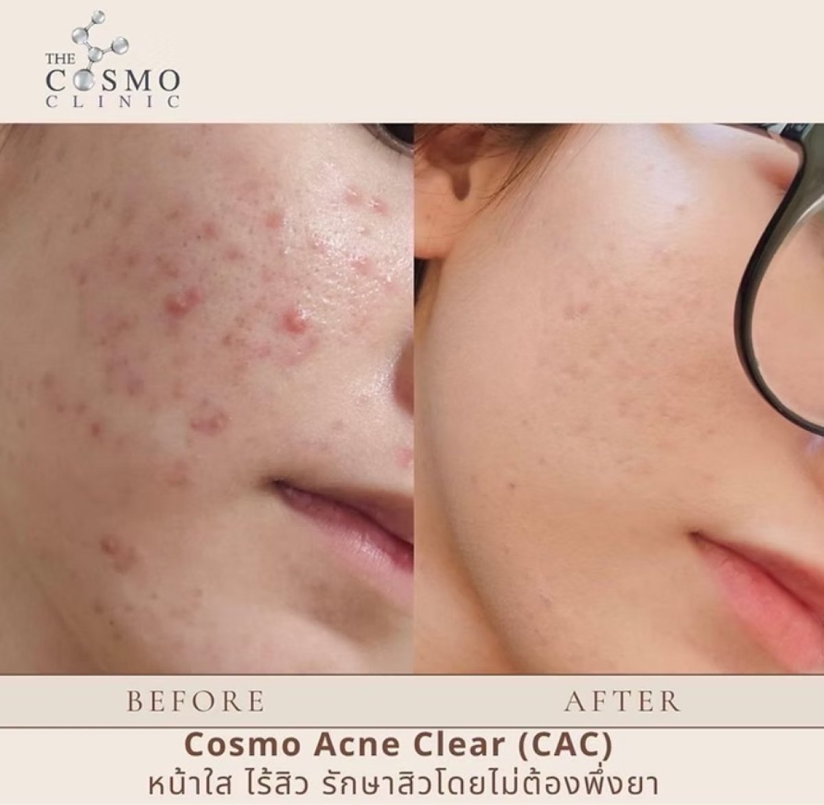 نتائج علاج ندبات حب الشباب قبل وبعد في The Cosmo Clinic، بشرة أكثر نعومة