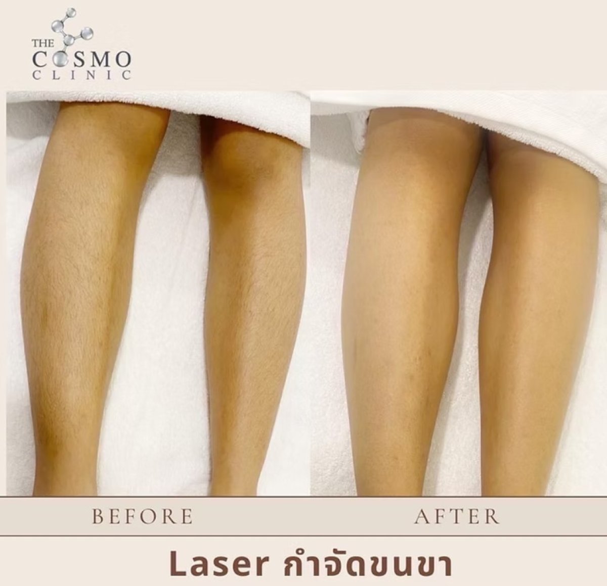 نتائج إزالة شعر الساقين بالليزر قبل وبعد في The Cosmo Clinic، بشرة أكثر نعومة