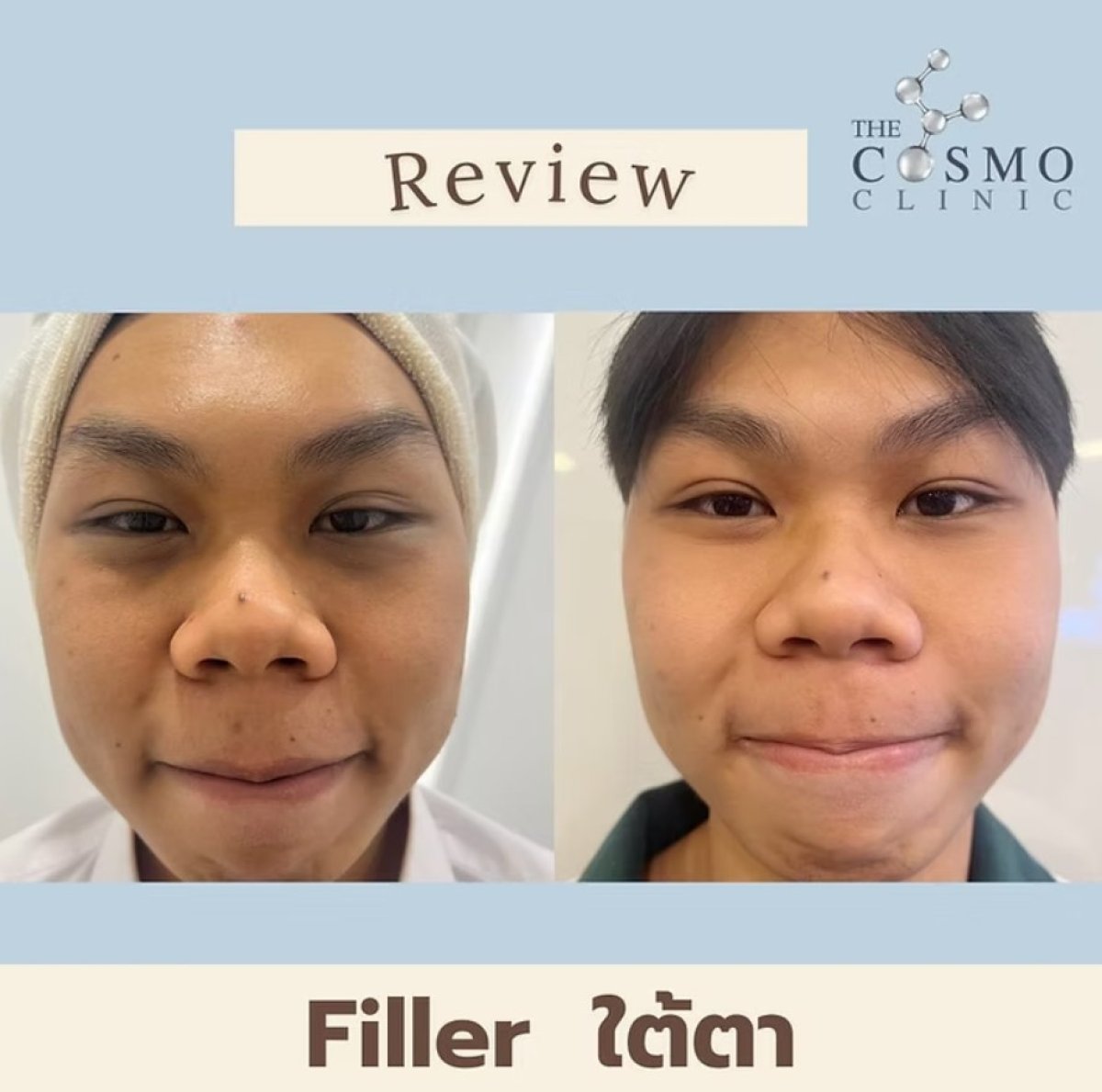 نتائج قبل وبعد حقن الفيلر تحت العين في The Cosmo Clinic لتقليل الهالات السوداء