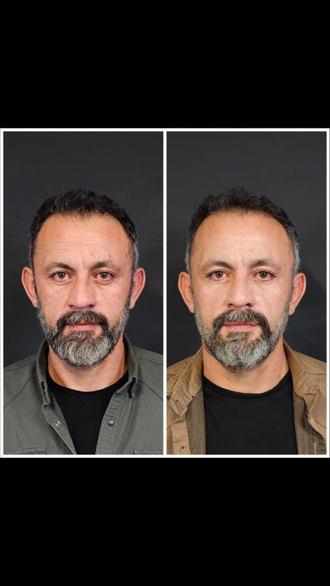 Facelift before and after results at VM Medical Park Pendik Hospital, visible facial rejuvenation