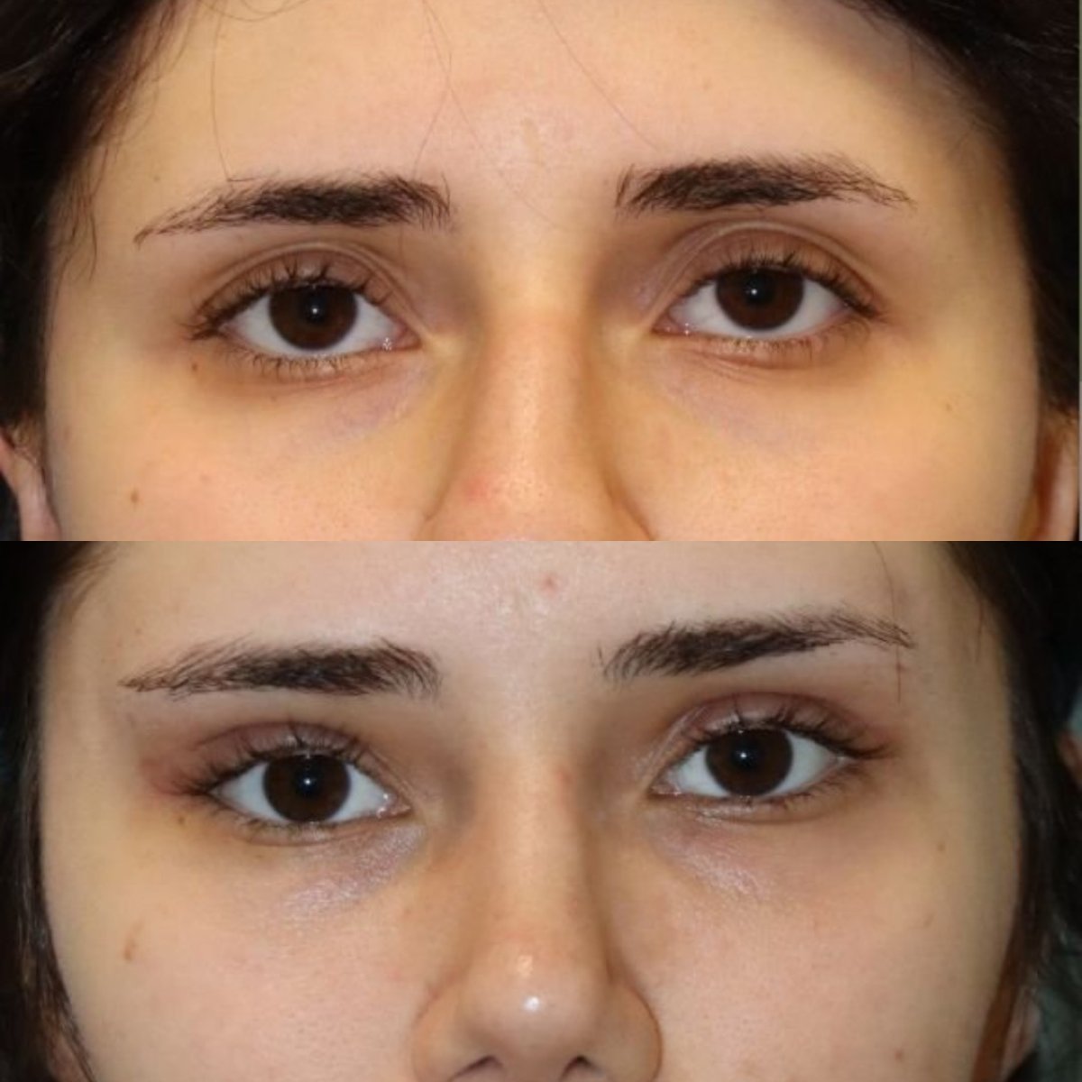 Résultats avant/après chirurgie des paupières supérieures à Memorial Şişli Hospital, yeux rajeunis