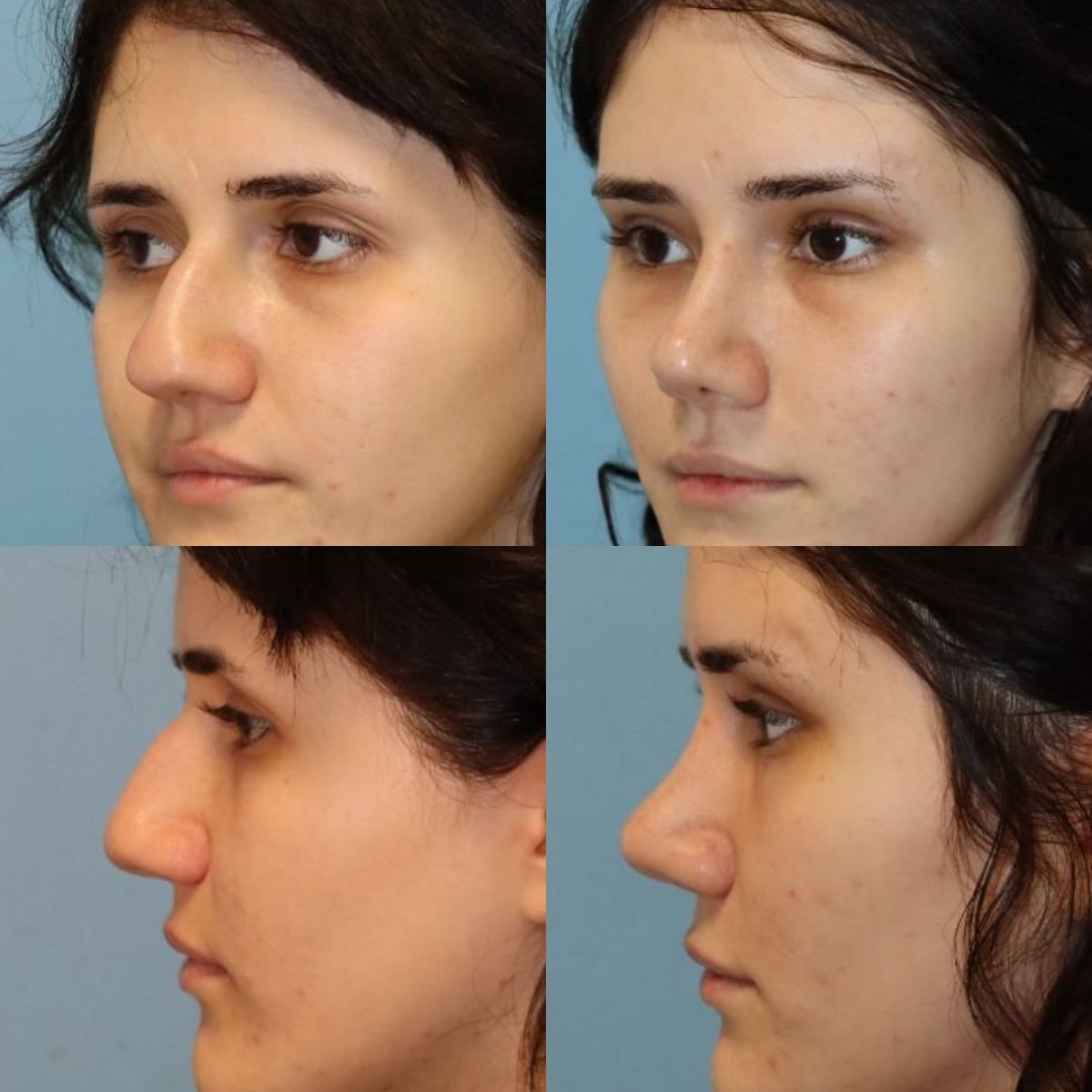 نتائج عملية تجميل الأنف قبل وبعد في مستشفى ميموريال شيشلي، إعادة تشكيل الأنف