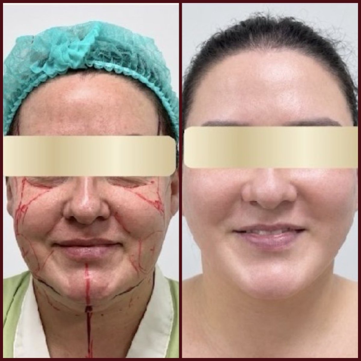 Resultados de lifting facial antes y después en DGB Clinic – rejuvenecimiento y contorno facial