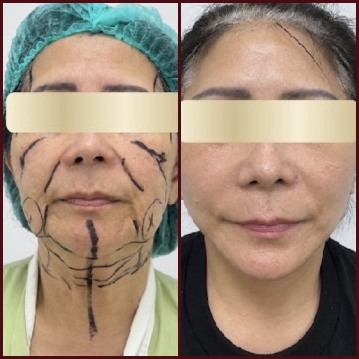 Resultados de lifting facial antes y después en DGB Clinic, rejuvenecimiento visible