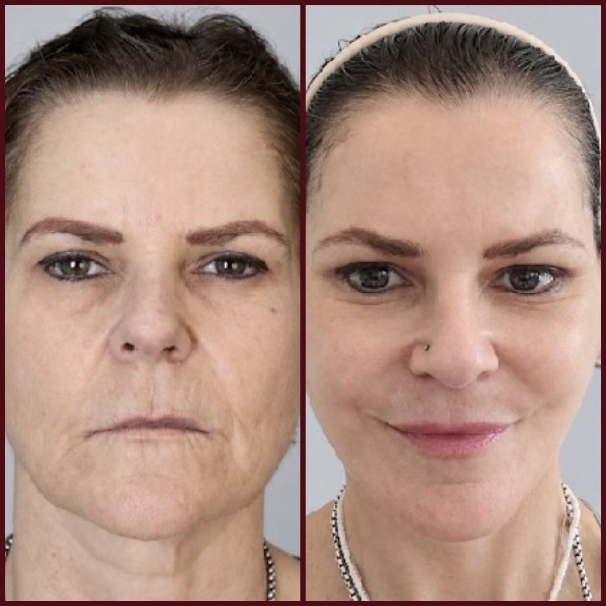 Resultados de lifting facial antes y después en DGB Clinic – rejuvenecimiento visible