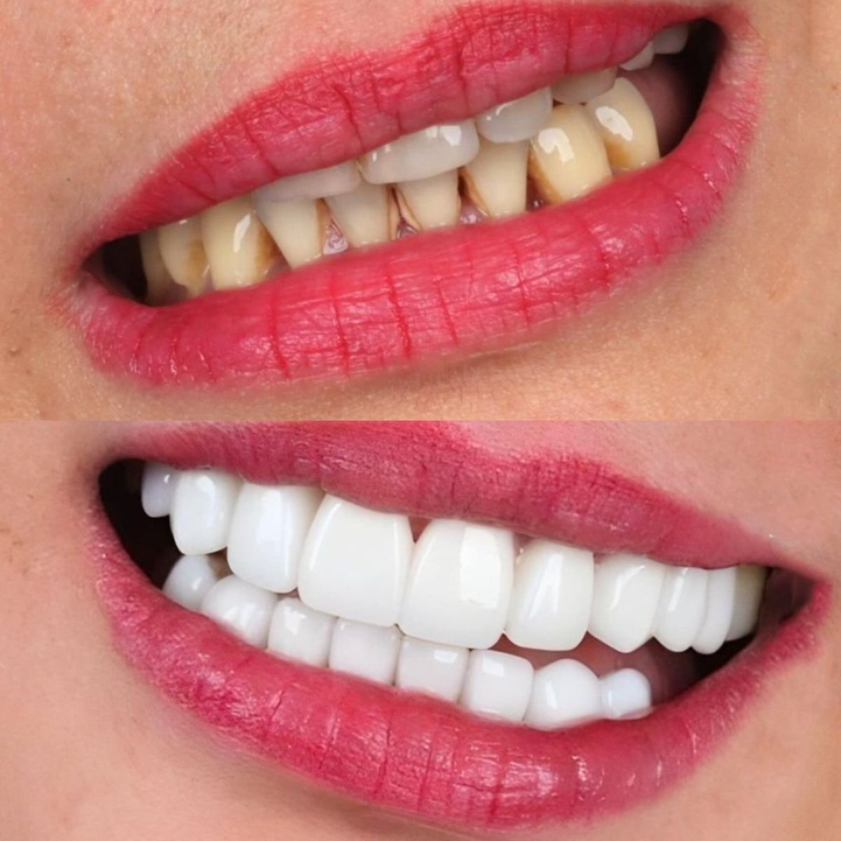 Результат до і після встановлення Emax вініри в SmileBox Dental Clinic - Thonglor, Sukhumvit