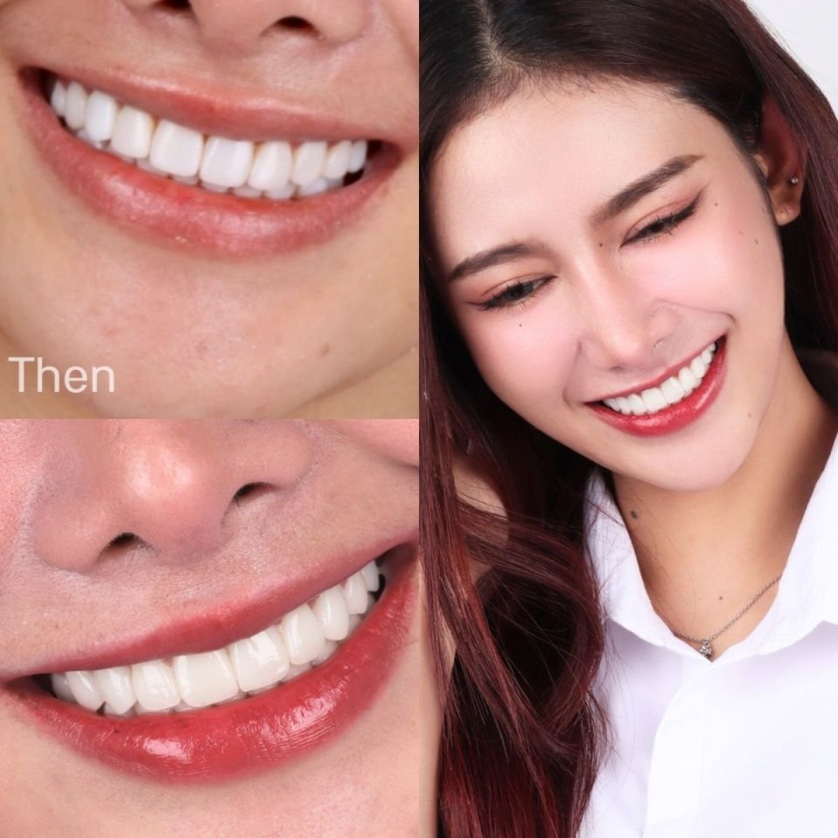 Before and after Emax veneers result at SmileBox Dental Clinic - Thonglor, Sukhumvit Branch