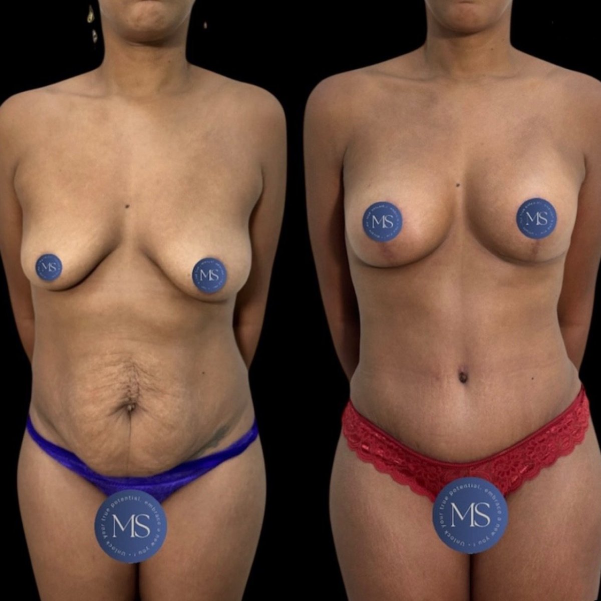 Resultados antes y después de aumento de senos en Dr. Michel Salameh - Plastic And Aesthetic Surgery