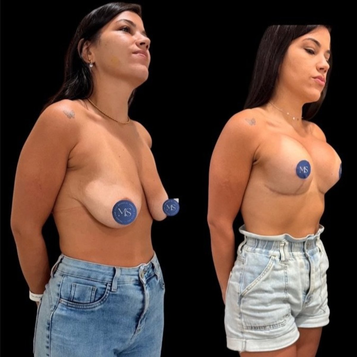 Resultados antes y después de aumento de senos en Dr. Michel Salameh - Plastic And Aesthetic Surgery