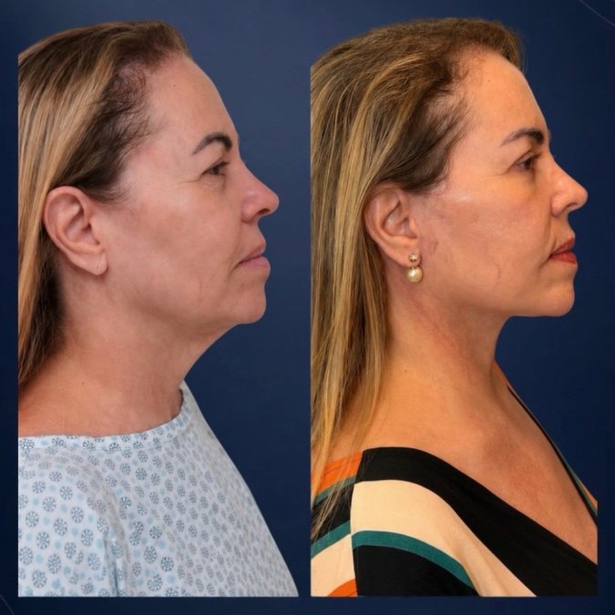 نتائج شد الوجه قبل وبعد في عيادة Dr. Michel Salameh - Plastic And Aesthetic Surgery