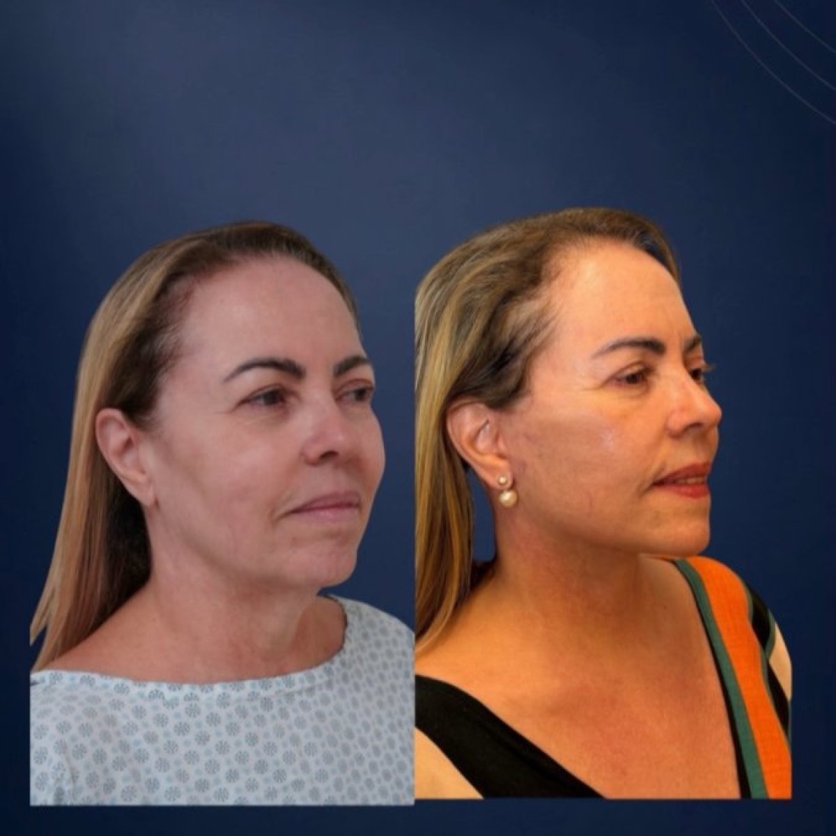 نتائج شد الجفون قبل وبعد في Dr. Michel Salameh - Plastic And Aesthetic Surgery
