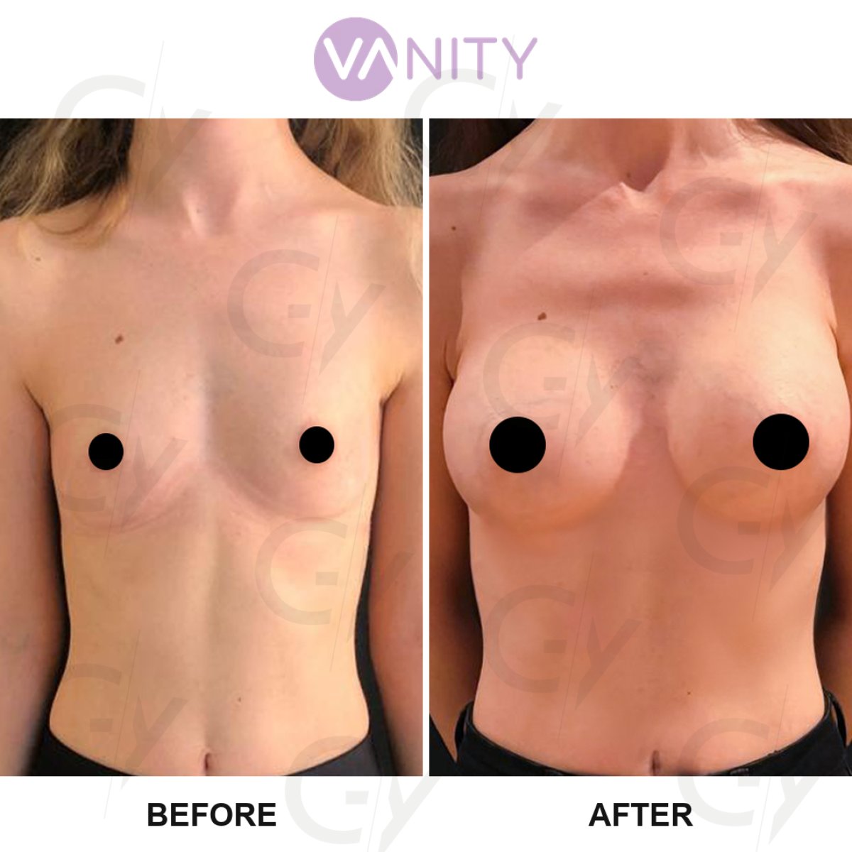 Resultados antes y después de aumento de senos en Vanity Cosmetic Surgery Center, mayor volumen