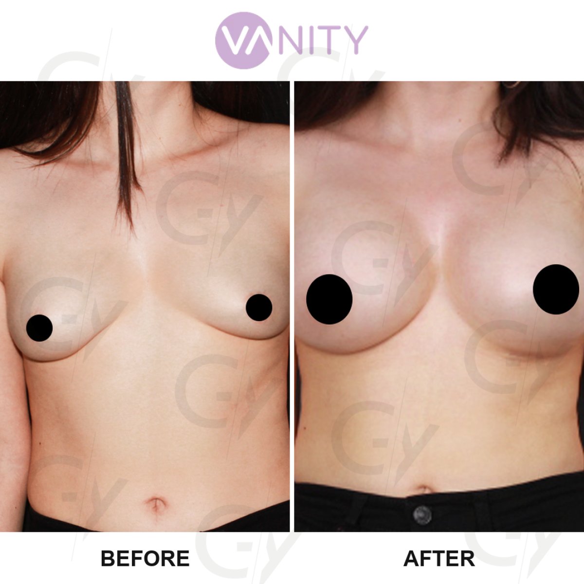 Vorher-nachher-Ergebnis Brustvergrößerung bei Vanity Cosmetic Surgery Center, vollere Brüste