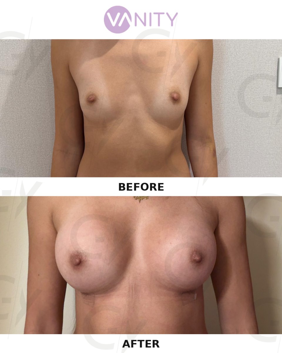 Resultados de aumento de senos antes y después en Vanity Cosmetic Surgery Center, senos más llenos